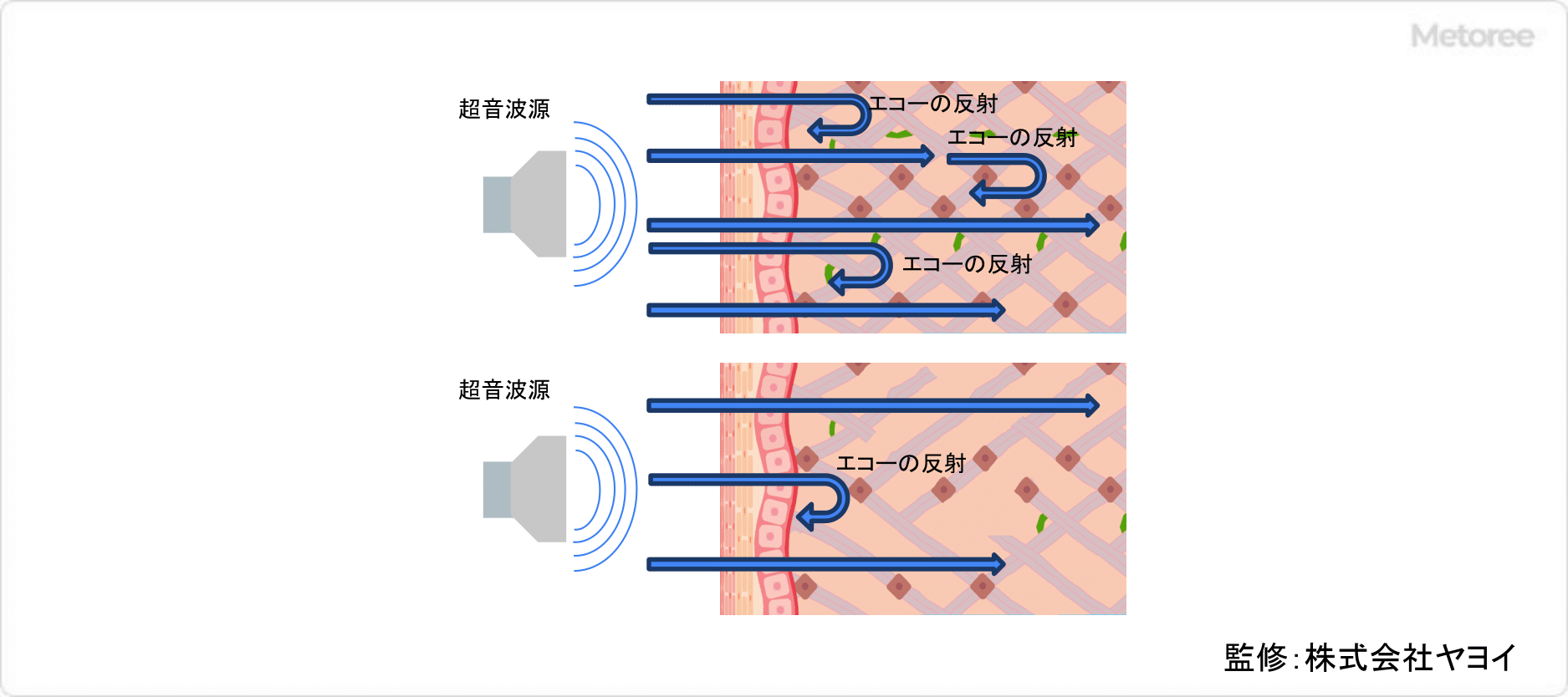 超音波で測定する肌チェッカーの仕組み